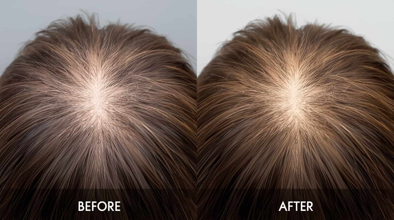 PRP Nutrafol hair growth