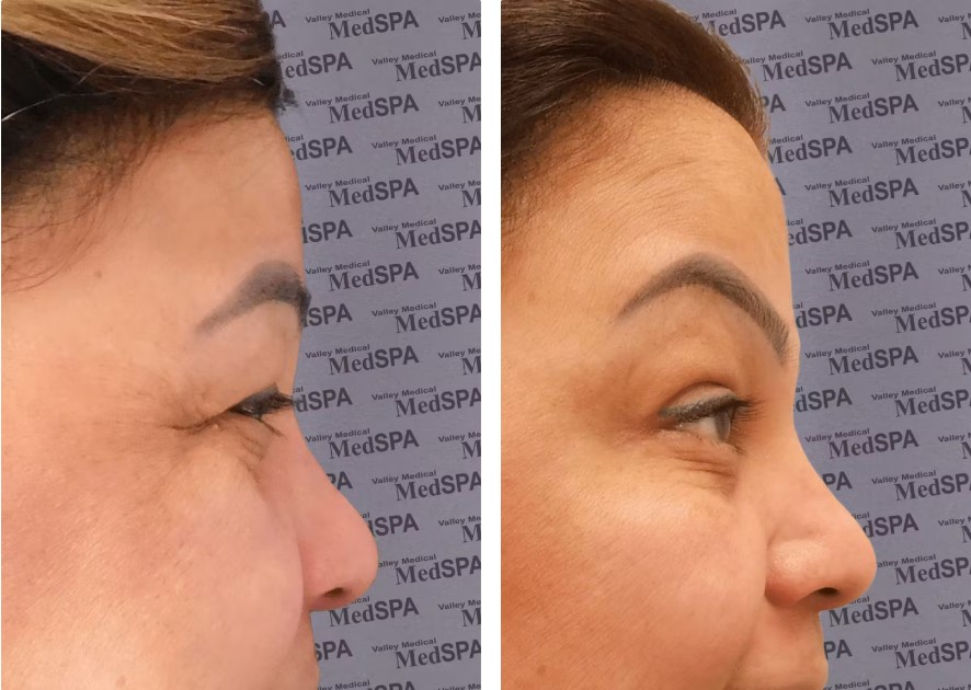 botox and tirzepatide BOTOX Before & After Photos