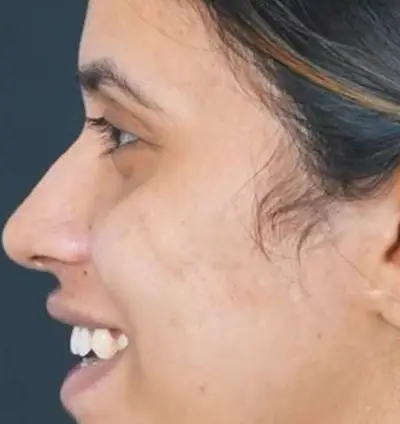 Face Scar After - Valley Medical Weight Loss & Med Spa - Valley Medical Weight Loss & Med Spa