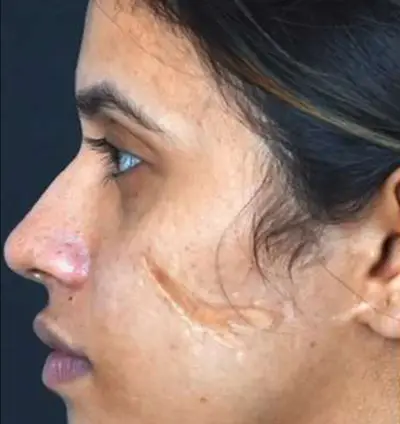 Face Scar Before - Valley Medical Weight Loss & Med Spa - Valley Medical Weight Loss & Med Spa