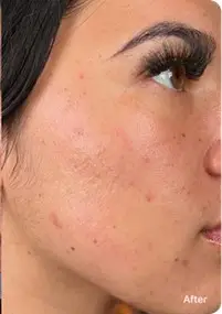 After Hydrafacial showing smoother skin texture and reduced fine lines