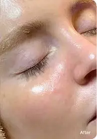 After Hydrafacial treatment showing reduced appearance of pores