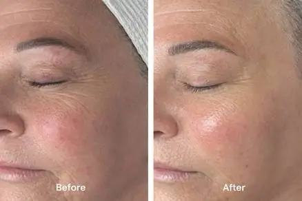 Before After