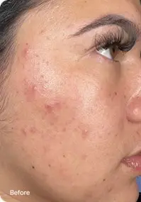 Before Hydrafacial showing smoother skin texture and reduced fine lines - Valley Medical Weight Loss & Med Spa - Valley Medical Weight Loss & Med Spa Before Hydrafacial showing smoother skin texture and reduced fine lines