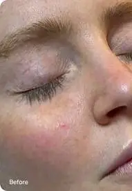 Before Hydrafacial treatment showing reduced appearance of pores - Valley Medical Weight Loss & Med Spa - Valley Medical Weight Loss & Med Spa Before Hydrafacial treatment showing reduced appearance of pores