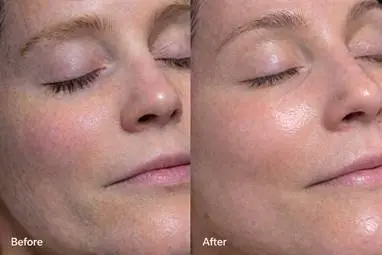 BeforeAfter
