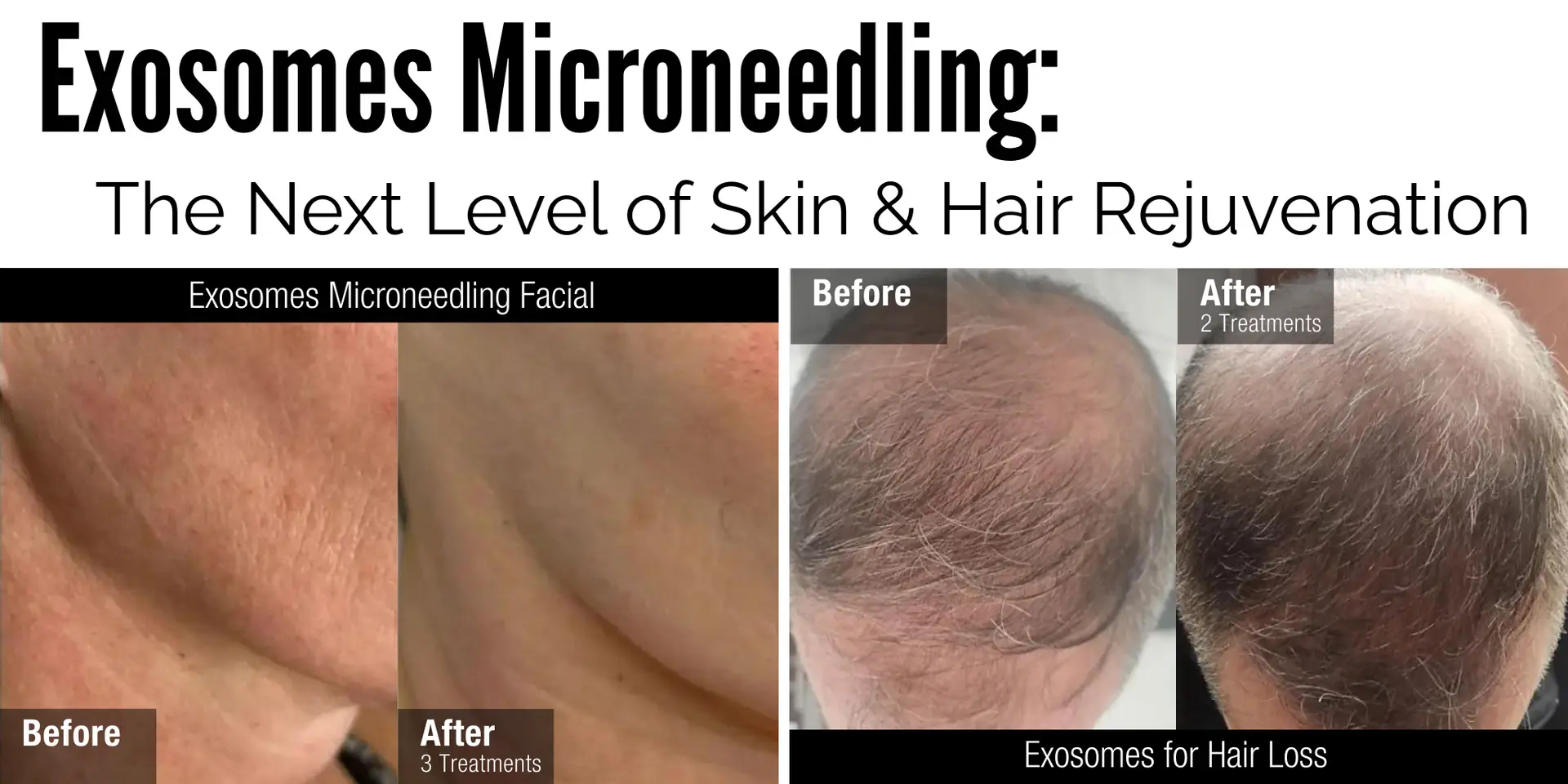 Exosome Microneedling