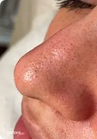 Hydrafacial clarifying treatment results for acne-prone and congested skin - Valley Medical Weight Loss & Med Spa - Valley Medical Weight Loss & Med Spa Hydrafacial clarifying treatment results for acne-prone and congested skin