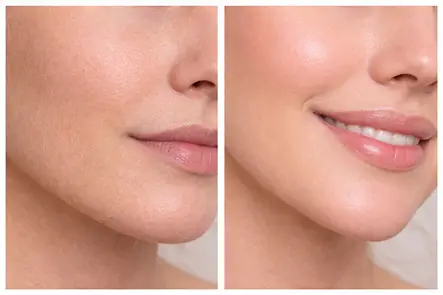 brighter looking skin before and after a professional dermaplaning session